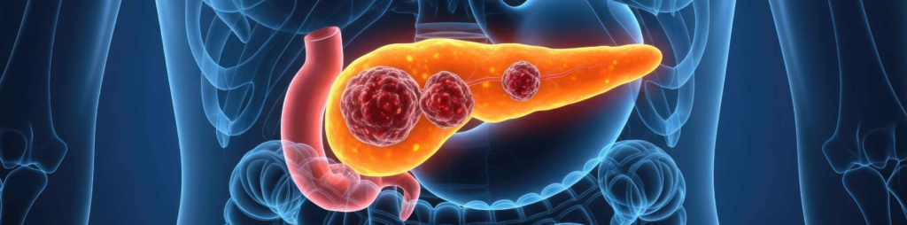 GI oncology surgeon consulting an international patient about pancreatic cancer treatment in India